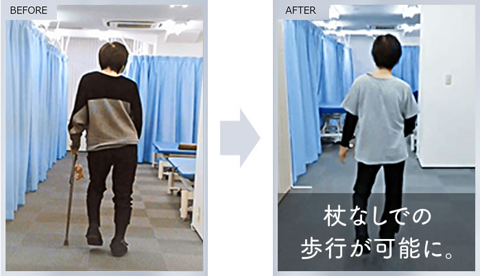 杖なしでの歩行が可能に